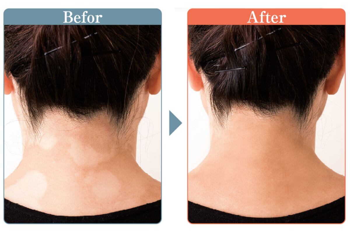 白斑（はくはん）の目立たない肌へ。「カバーしたい」にメイクで応える【マーシュフィールド】