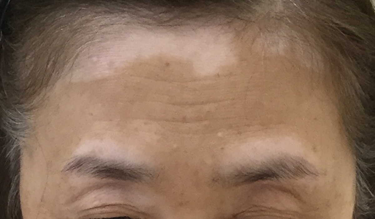 白斑（額）のカバー例