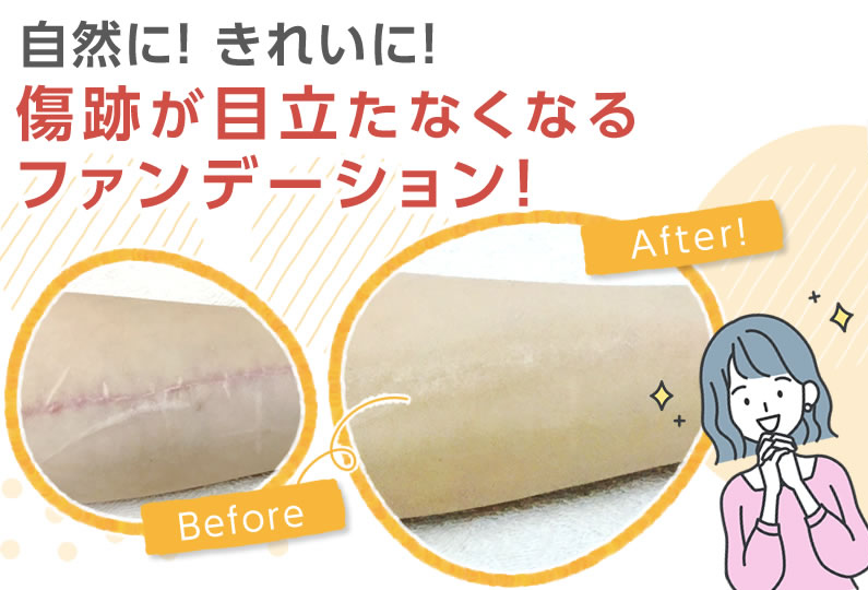 公式☆傷跡、手術跡を隠すボディカバーファンデ/自然に！きれいに