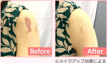 公式☆傷跡、手術跡を隠すボディカバーファンデ/自然に！きれいに