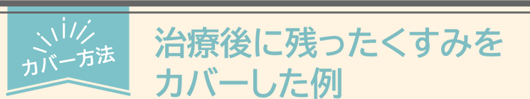 治療後に残ったくすみをカバーした例